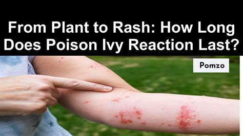 Severe Poison Ivy Rash