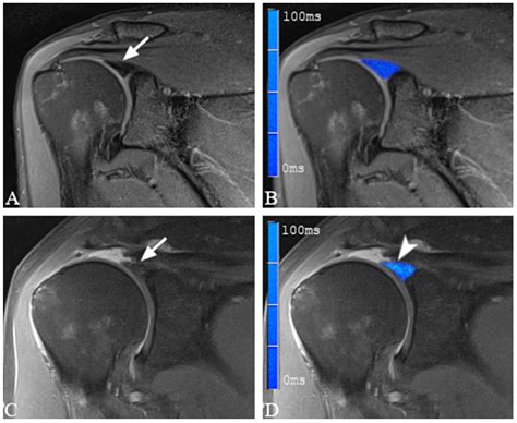 3-Tesla T2 Mapping Magnetic Resonance Imaging for Evaluation of SLAP ...