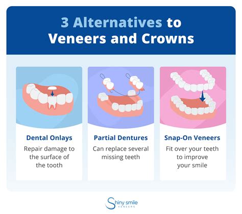 Alternative To Veneers Uk at Joan Dudley blog