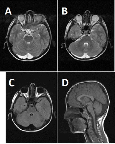 Mega Cisterna Magna Vs Arachnoid Cyst