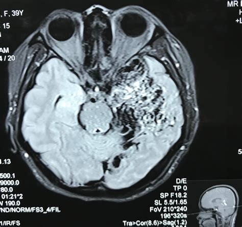 Image result for AVM Brain