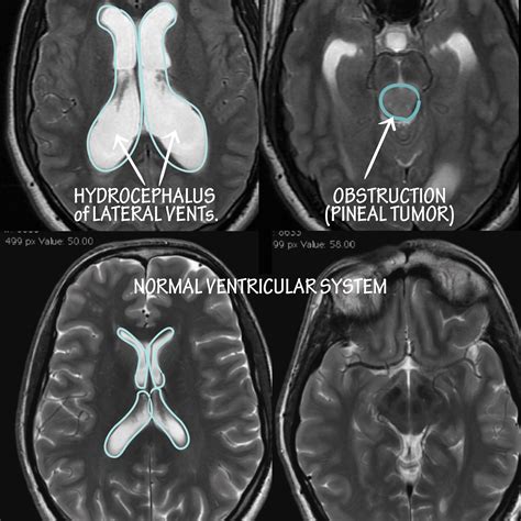 Neuroanatomy Glossary: Hydrocephalus: Obstructive | ditki medical ...