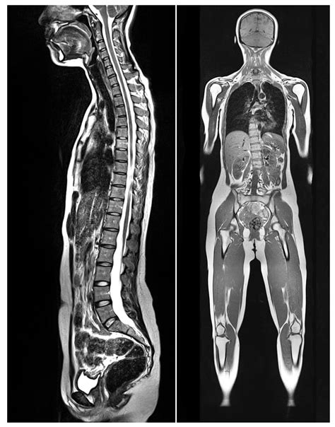 Cancer Resource Crusaders: MEET PRENUVO: ADVANCED FULL BODY MRI FOR ...