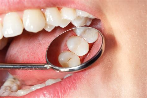 Dental Filling Procedure: What To Expect | Enamel Dental Centre