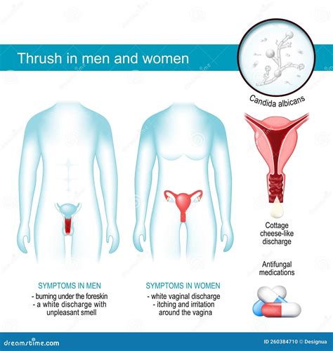 Thrush in Men and Women. Yeast Infection Stock Vector - Illustration of ...