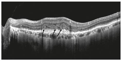 Prognostic Optical Coherence Tomography Biomarkers in Neovascular Age-Related Macular Degeneration