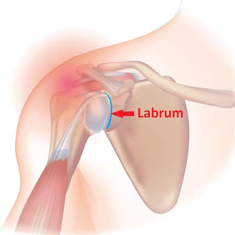 Image result for Shoulder Labral Tear Surgery