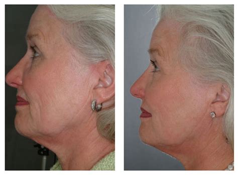 Medaglia Sentimentale Passivo skin firming laser ossigeno benedizione ...