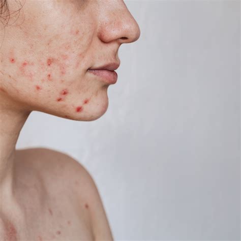 Common Skin Conditions: What's Contagious and What's Not? - Bryn Mawr Dermatology