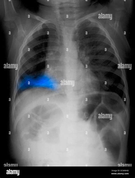 Left Lobar Pneumonia X Ray