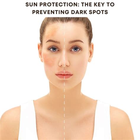 Quick and Natural Remedies to Fade Dark Spots on Your Face | Clinikally