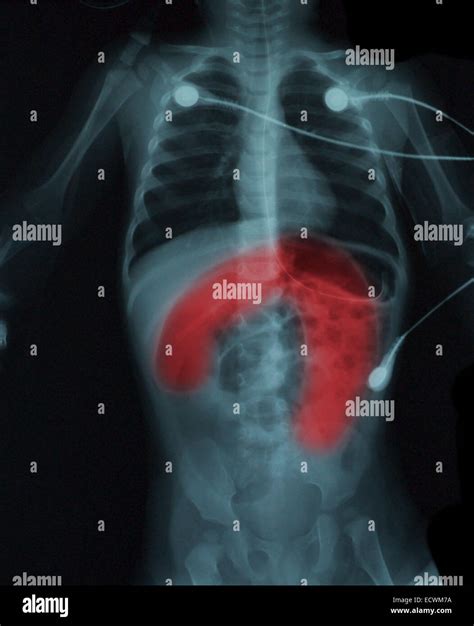Infant x ray hi-res stock photography and images - Alamy