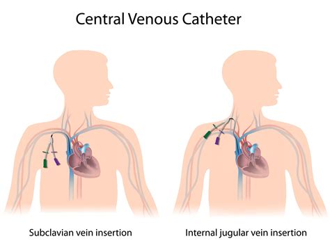 Central Venous Catheter Subclavian