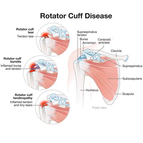 Rotator Cuff Injuries: Causes, Braces, & Recovery Tips — Brace Direct