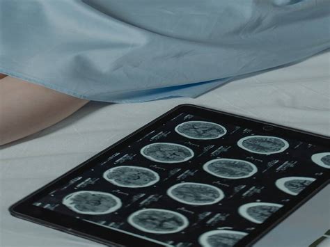 Alzheimer’s Breakthrough: Drug Lecanemab Found To Delay Brain Cell ...