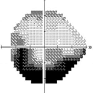 Image result for Check Visual Fields