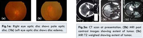 Petroclival Meningioma Presenting as Foster Kennedy Syndrome: A Rare ...