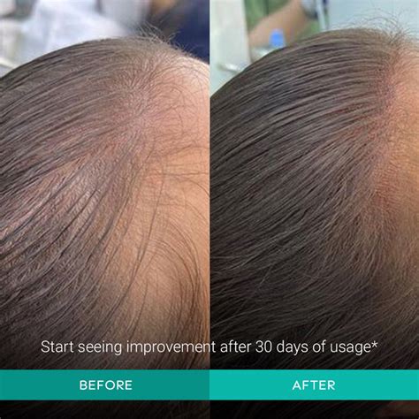 Intensive Hair Growth Serum - 30ml – Arata