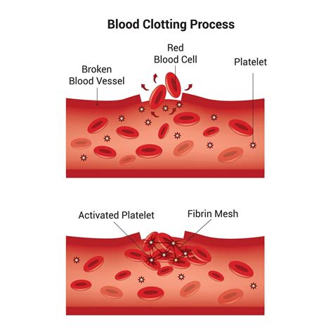 Process of Blood Clotting 的图像结果