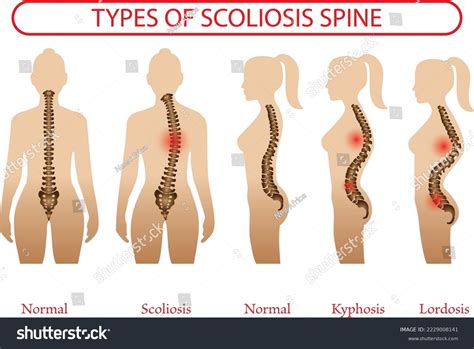 Medical Poster Demonstrating Types Scoliosis On Stock Vector (Royalty Free) 2229008141 ...
