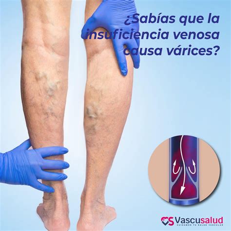 ¿Sabías qué la insuficiencia venosa causa várices?