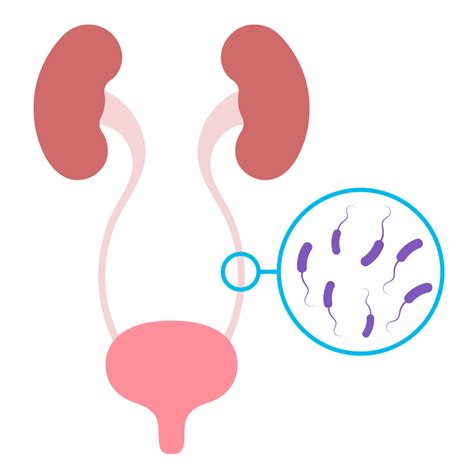 URINARY TRACT INFECTION (FEMALE) - Causes, Symptoms & Treatments with ...