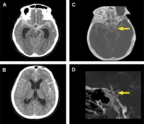 Modern Imaging of Aneurysmal Subarachnoid Hemorrhage - Radiologic Clinics