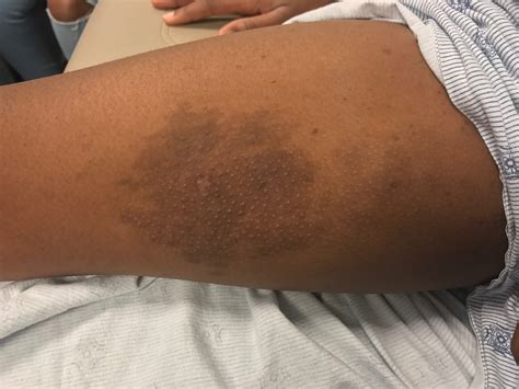 Dark Patches On Legs