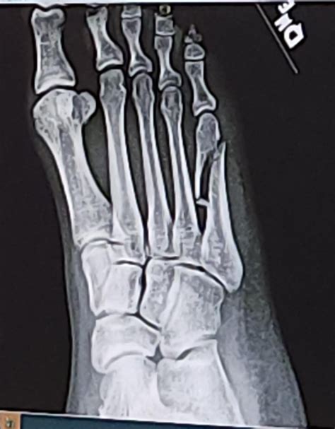 3rd Metatarsal Fracture Stress Fractures Of The Foot OrthoPaedia