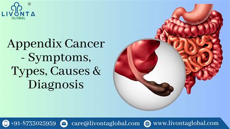 Image result for Appendix Cancer Symptoms
