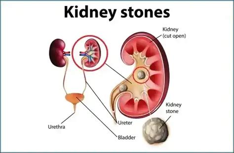 Kidney stones: Types, Symptoms, Causes and Treatments