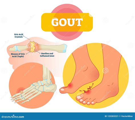 Tums And Gout at Milla Stelzer blog