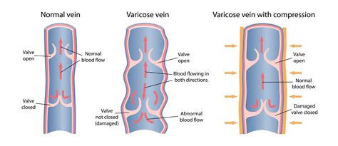 Valves Function In Veins at Christy Calvin blog