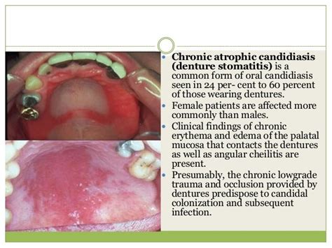 Candidiasis