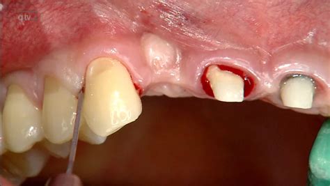 Implant placement using a modified roll flap technique | Quintessence ...