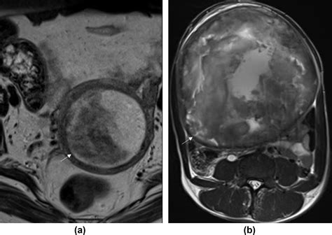 The role of multiparametric MRI in differentiating uterine ...