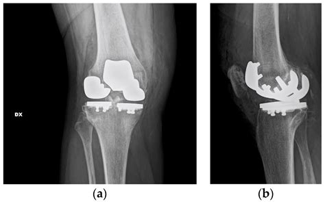 One-Stage Tricompartmental Hypoallergenic UKA for Tricompartmental ...