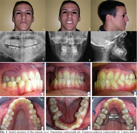 Figure 1 from Surgical and orthodontic rapid palatal expansion in adults using a modified ...