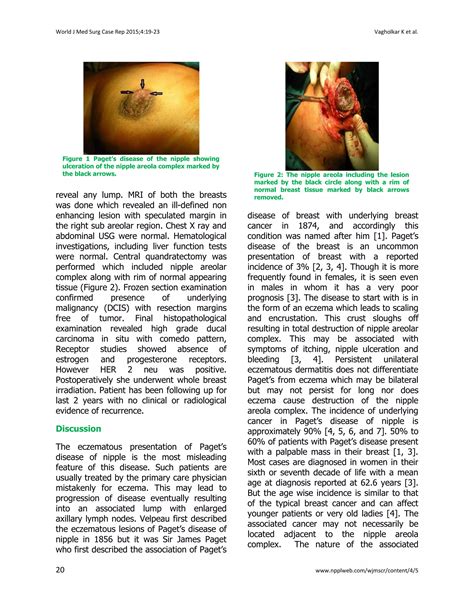 Paget's Disease of the Breast | PDF