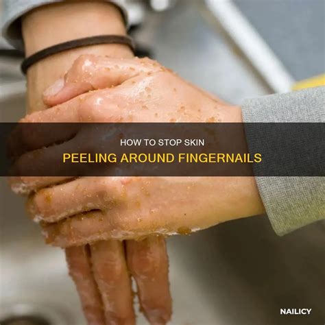 How To Stop Skin Peeling Around Fingernails | Nailicy