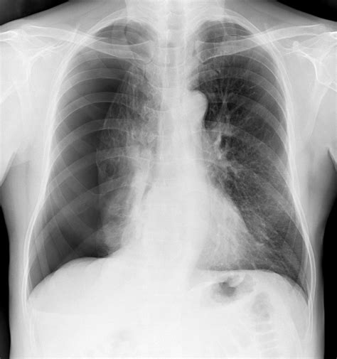 Atelectasis Chest X Ray