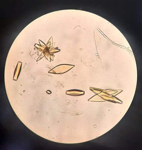 Uric Acid Crystals in Urine - BioDiagnostica laboratory Belgrade