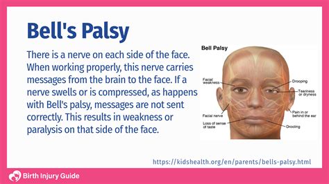 Bell's Palsy Ct Scan at Kate Terry blog