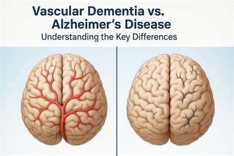 Vascular Dementia vs. Alzheimer’s Disease: Understanding the Key ...
