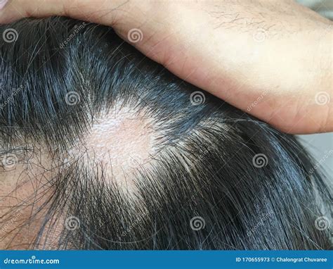Close Up of Symptoms of Hair Loss from Stress on the Scalp Stock Image ...