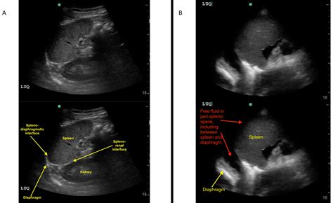 创伤超声重点评估 （FAST） 检查:图像采集
