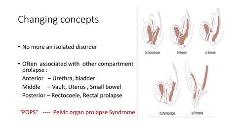 Rectal prolapse: Do we really have a perfect surgical solution? pptx copy | PPTX