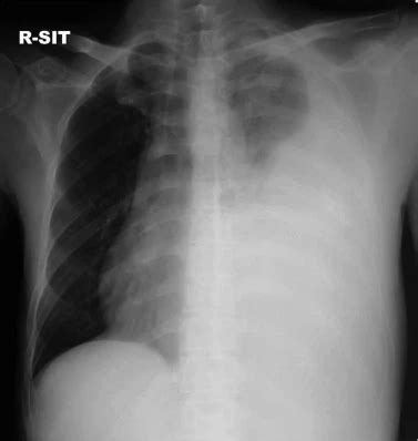 El signo de afectación extrapleural en la radiología torácica | Live-Med