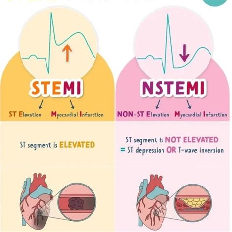 What Is Stemi