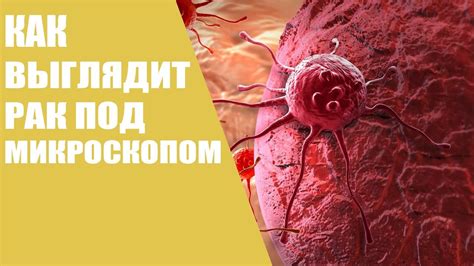 Как выглядт рак под микроскопом - YouTube
